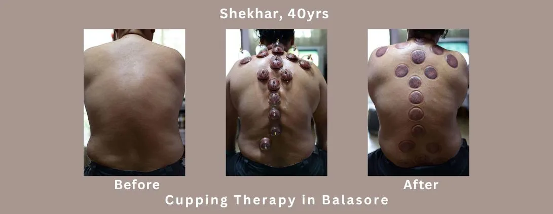 Cupping-Therapy-rs500-for-one-time
