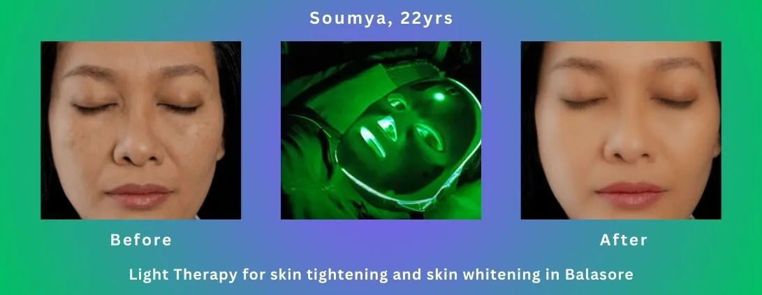 Light Therapy for skin tightening and skin whitening treatment-rs2000-for one time