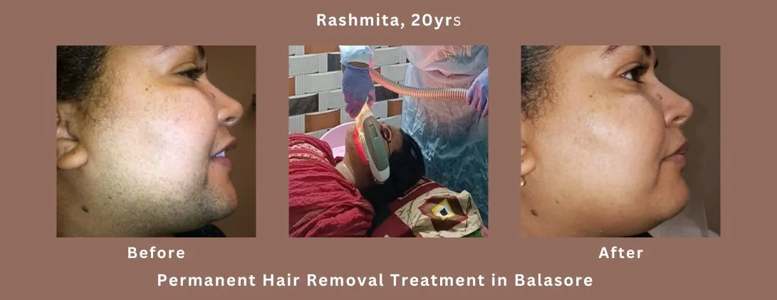 Permanent hair removal Treatment-rs2000-for one time