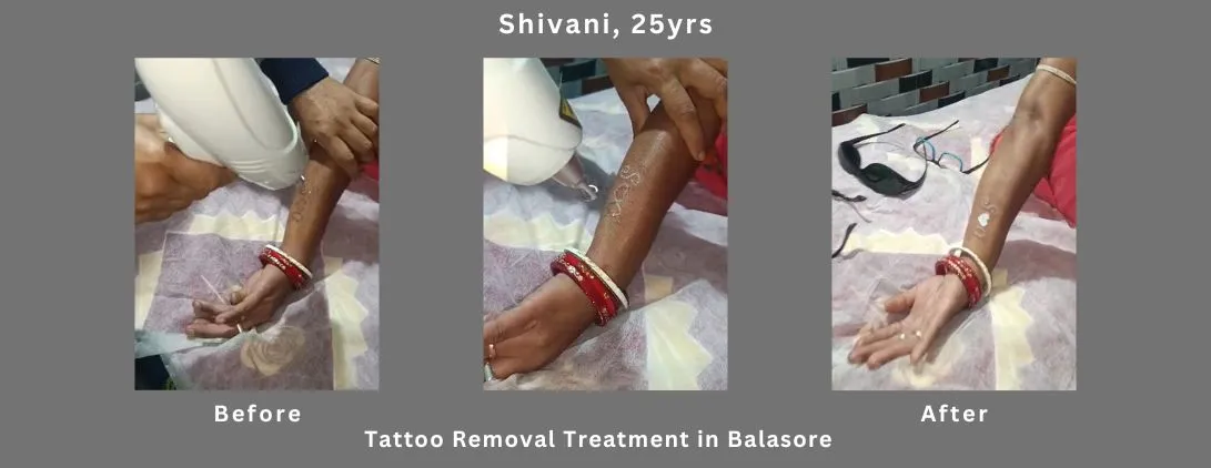 Tattoo-removal-rs500-for one time